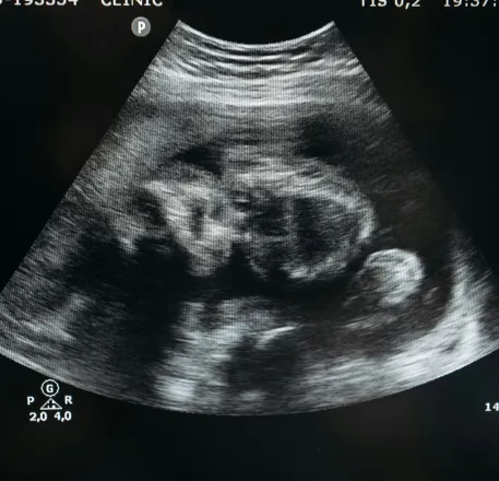 Ultrasound scan showing the image of an unborn child in the womb, highlighting pregnancy and healthcare.