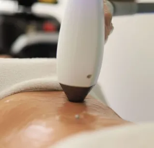 Detailed view of a laser treatment on skin at a medical clinic in İstanbul.